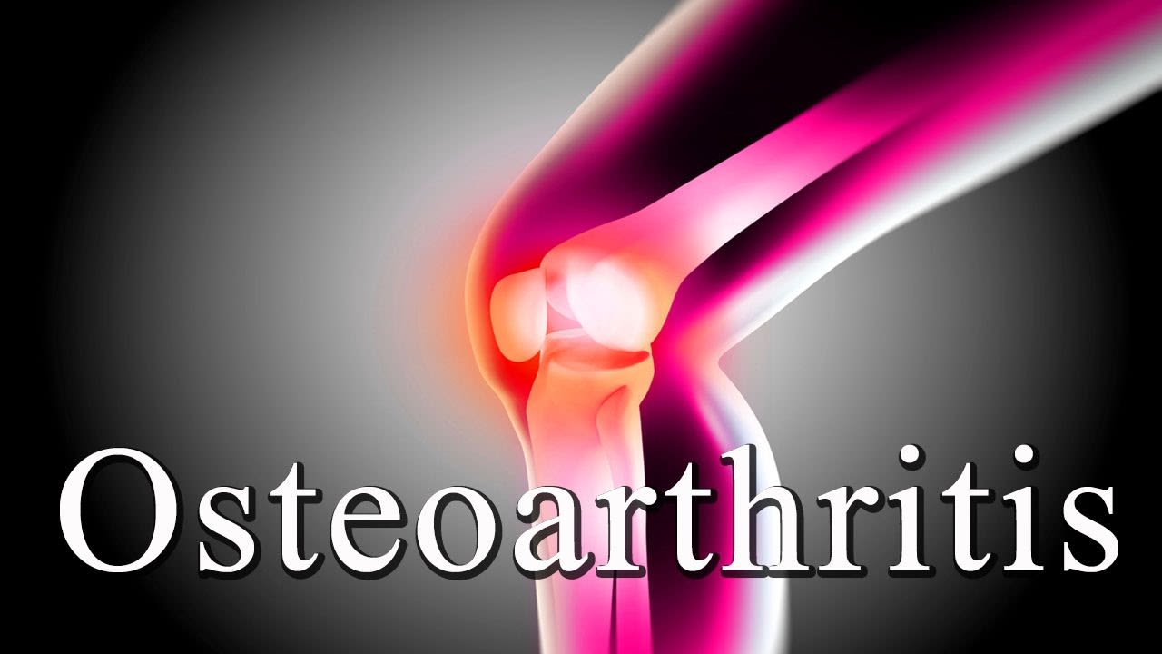 Treatment of osteoarthritis without operation