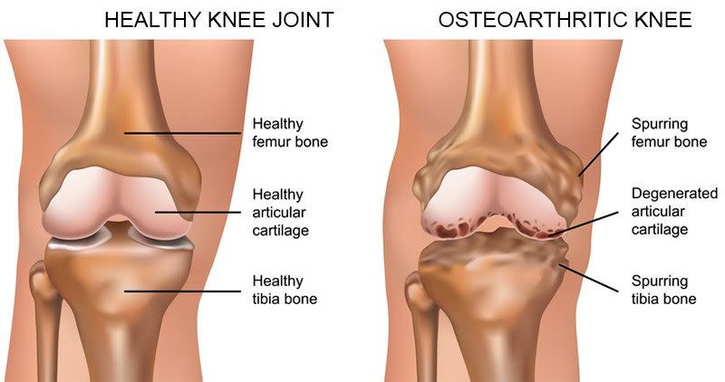arthritic knee blog
