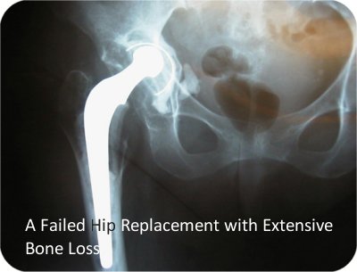 failed hip replacement