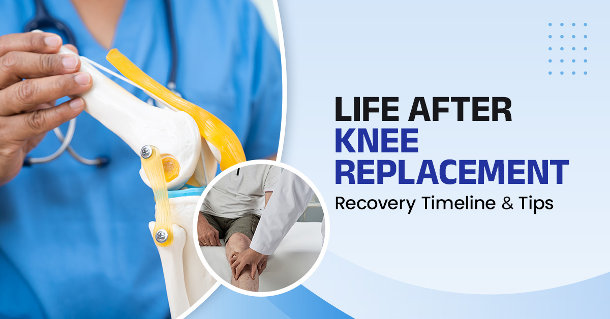 Life After Knee Replacement: Recovery Timeline & Tips