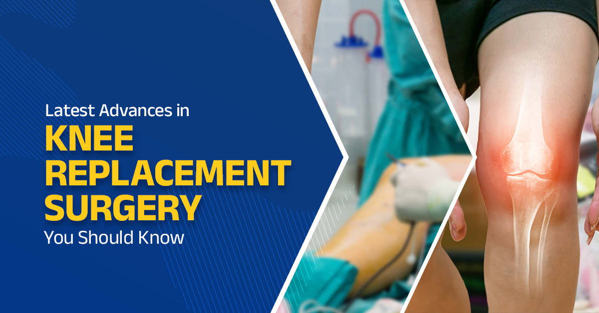 Latest Advances in Knee Replacement Surgery You Should Know